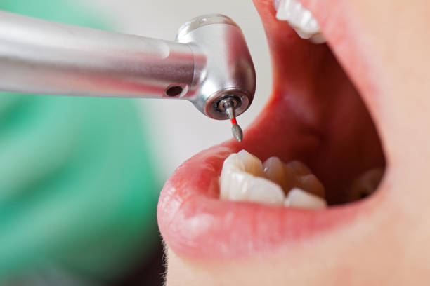 Best Emergency Tooth Extraction in Center Hill, FL